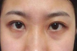 黑眼圈重怎么快速消除？四个去黑圈最有效的方法