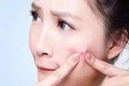 姨妈痘的预防方法 轻松解决经期困扰