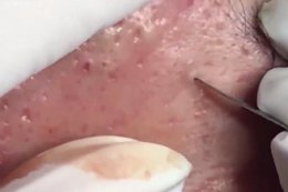 如何把脸上的黑头去掉？三个去黑头最有效的方法