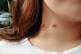 胸上种的草莓怎么快速消除 胸部种的草莓怎么样快速消除