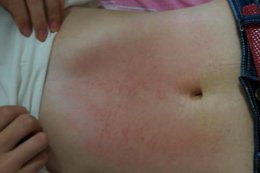 脖子的淋巴用什么精油? 用精油刮脖子淋巴可以祛痘吗