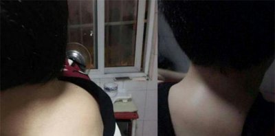 富贵包是颈椎病吗 来了解下富贵包怎么形成的
