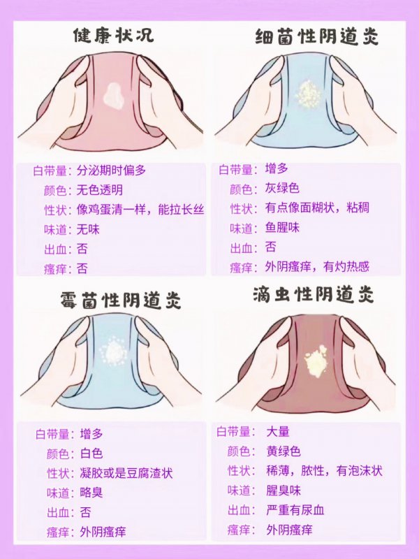 白带增多伴有这些症状警惕妇科炎症