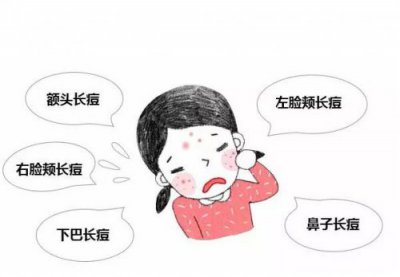 你知道脸上为什么长痘痘？都写在脸上