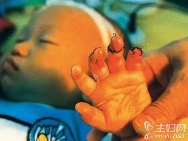 1岁女童手指被扶梯夹断引热议 家长带孩子乘电梯要注意什么