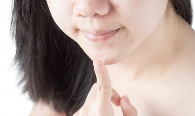 痘痘肌肤护肤常识 轻松消灭痘痘