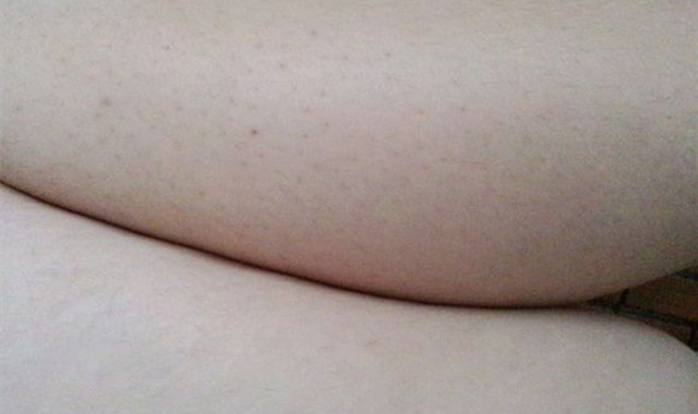 鸡皮肤去角质 轻松改变粗糙印象