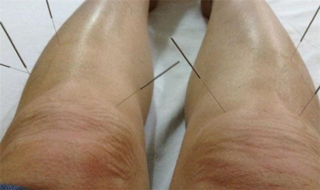 腿疼针灸管用吗 如何健康养生有方法