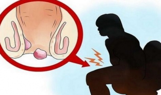 如何预防痔疮 介绍以下方法