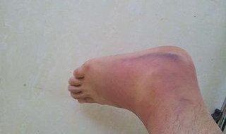 脚被开水烫了怎么办 涂什么最具效