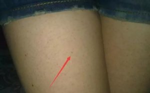 疙瘩鸡皮肤是怎么引起的 鸡皮肤怎么消除最具效