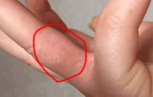 手指起水泡怎么回事 手指上有小水泡很痒和不痒的区分