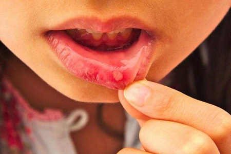 女人舌头溃疡怎么办？这几点家庭护理办法能好得快