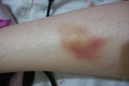 女性腿上经常出现淤青 三个原因皮肤淤斑的警告