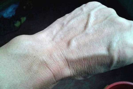 青筋凸起是什么原因 3种青筋凸起原因要及时治疗