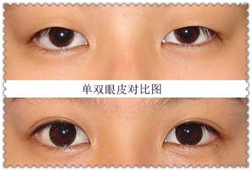 双眼皮贴贴久了会怎样 双眼皮贴久了有害吗？