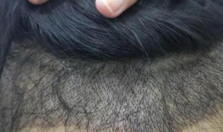 头发能够种植吗 头发能不能种植