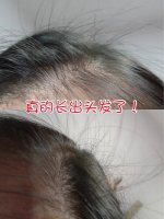 生发养发篇‼️1个月长出小绒毛