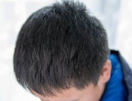 少年白头发应该如何调理方法 少年白发的原因怎么治疗